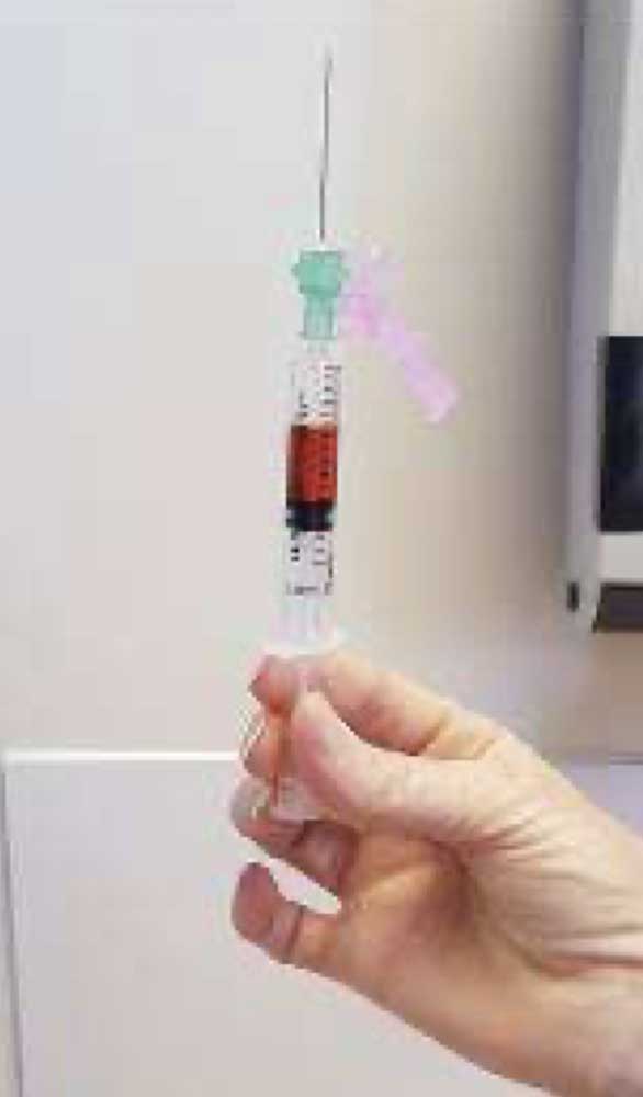 tap syringe